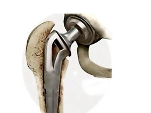 Hip - Performance Plus