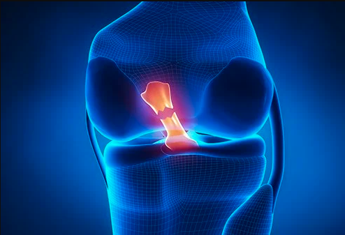 Screen Shot 2021-05-19 at 2.42.14 pm - Performance Plus ACL tear